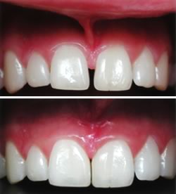 Frenectomy Before and After