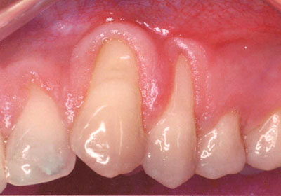 Gum grafting by Periodontist in Pittsburgh PA