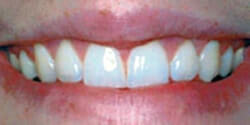 After Cosmetic Dentistry Gum Surgery by Periodontist in Pittsburgh PA