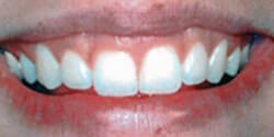 Gummy Teeth before Cosmetic Dentistry by Periodontist in Pittsburgh PA