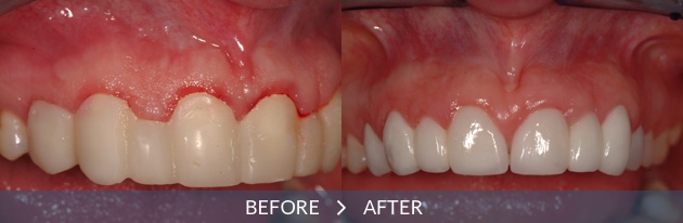 Dental Implants