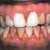 Gum Disease in Children treated by Periodontist in Pittsburgh PA