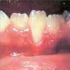 Gum Disease in Children treated by Periodontist in Pittsburgh PA