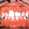 Gum Disease in Children treated by Periodontist in Pittsburgh PA
