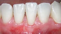 Gum grafting by Periodontist in Pittsburgh PA