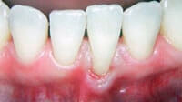 Gum grafting by Periodontist in Pittsburgh PA