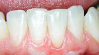 Gum grafting by Periodontist in Pittsburgh PA