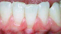 Gum grafting by Periodontist in Pittsburgh PA