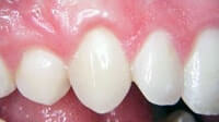 Gum grafting by Periodontist in Pittsburgh PA