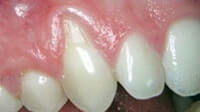 Gum grafting by Periodontist in Pittsburgh PA