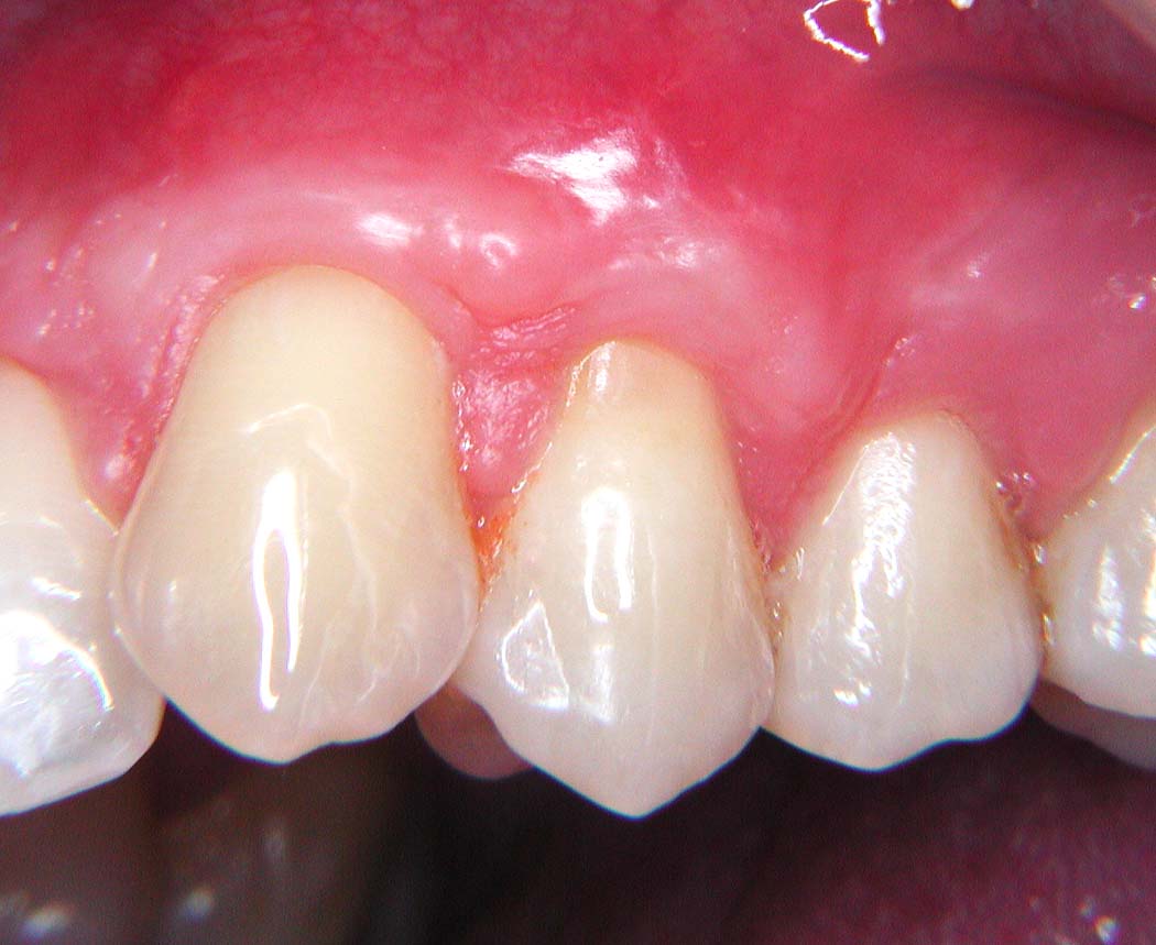 Gum grafting by Periodontist in Pittsburgh PA