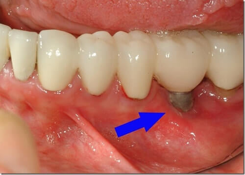Dental Implant with loss of gum on their teeth