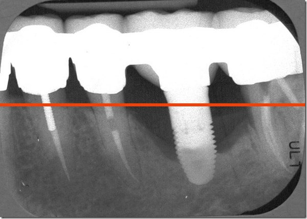 Dental Implant with the loss of bone from poor maintenance
