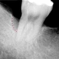 Regenerating bone by Periodontist in Pittsburgh PA