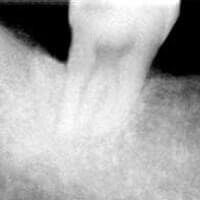 Regenerating bone by Periodontist in Pittsburgh PA