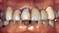 Ridge Augmentation may be recommended when the tooth ridge collapses. Periodontist Pittsburgh PA