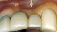 Ridge Augmentation may be recommended when the tooth ridge collapses. Periodontist Pittsburgh PA