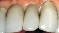 Ridge Augmentation may be recommended when the tooth ridge collapses. Periodontist Pittsburgh PA