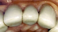 Ridge Augmentation may be recommended when the tooth ridge collapses. Periodontist Pittsburgh PA