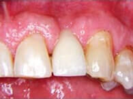 Ridge Preservation necessary when Teeth Extracted to Prevent Ridge Collapse, Periodontist Pittsburgh PA