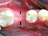 Ridge Preservation necessary when Teeth Extracted to Prevent Ridge Collapse, Periodontist Pittsburgh PA
