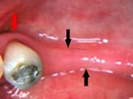 Ridge Preservation necessary when Teeth Extracted to Prevent Ridge Collapse, Periodontist Pittsburgh PA