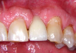 Tooth Loss, bone ridge collapses.