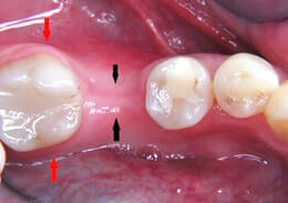 Tooth Loss, bone ridge collapses.