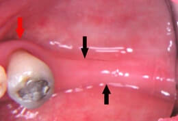 Tooth Loss, bone ridge collapses.