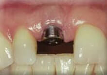 Dental Implant post placed and prepared by Dr. Silberg, Periodontist in Pittsburgh PA