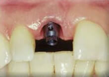 Dental Implant implant post placed by Dr. Silberg, Periodontist in Pittsburgh PA