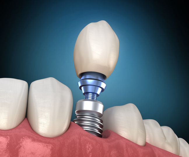 3D illustration of human teeth and dental implant.