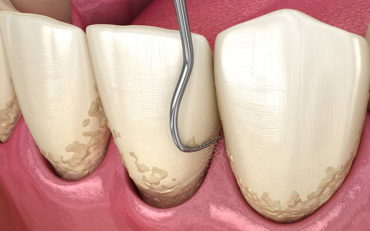 Scaling & Root Planing vs. a “Regular” Cleaning: Why Deep Cleanings Matter for Gum Health