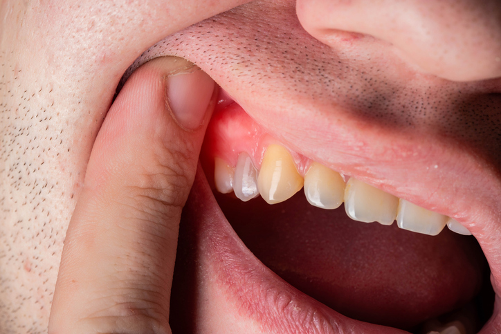 Red and swollen gums in a man with gum disease.