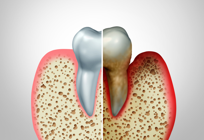 3D illustration of gum disease comparison with a healthy tooth and an unhealthy one with periodontitis.